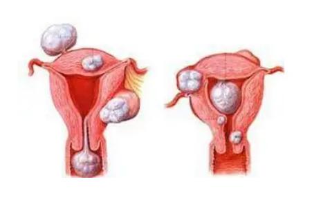 女性子宫肌瘤不做手术对身体有什么影响？