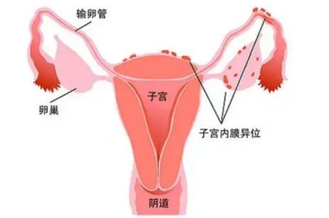 子宫内膜异位症做腹腔镜手术治疗有什么好处？