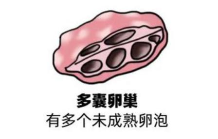 造成女性多囊卵巢的原因是什么？