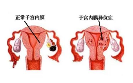 子宫内膜异位症做人工受孕的优缺点是什么？