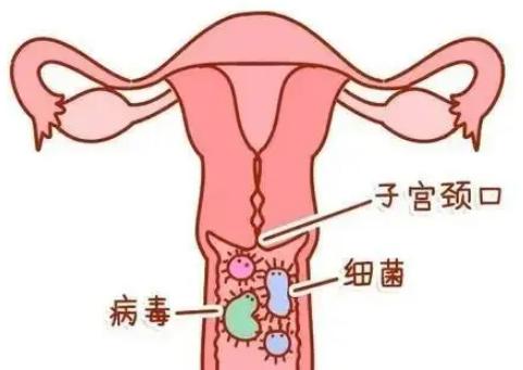 女性患上了宫颈癌在早期一定要切除子宫吗？