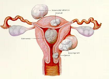 子宫肌瘤切除之后还会再出现肌瘤吗？