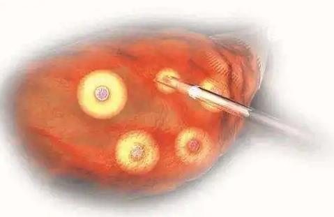试管婴儿卵泡黄素化可以做吗?