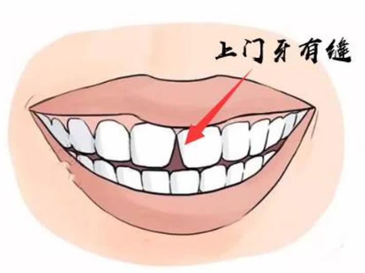 十个月的孩子门牙门缝间距太大，应该怎么办？