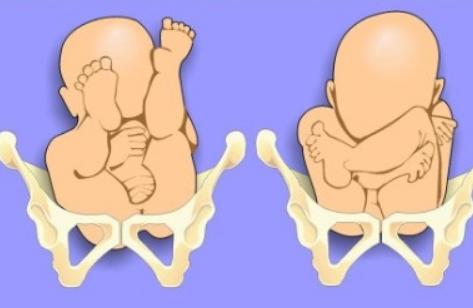 孕晚期胎儿臀位还能等胎儿自动发动吗？