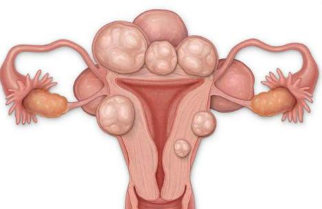 导致特殊型子宫肌瘤出现的原因有哪些？