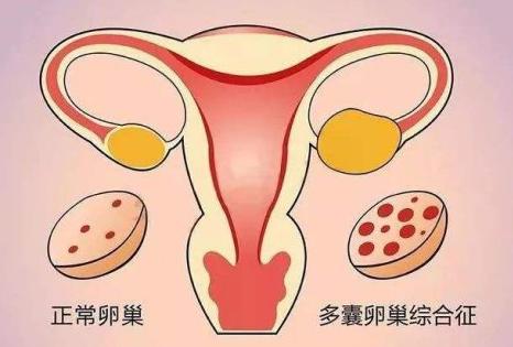 单侧卵巢中窦卵泡12个是患上了多囊卵巢吗？