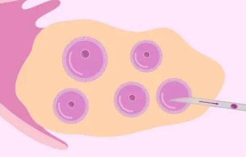 做一次试管取卵手术要花多少钱？