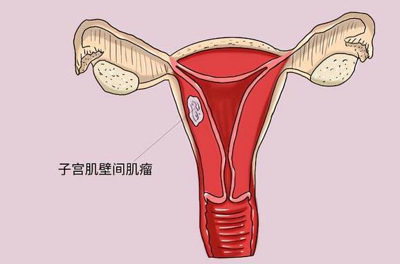 25岁患有子宫腺肌症，什么时候做手术最好？