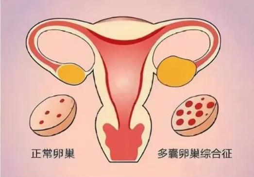 多囊促排后取卵20个能成功配成几个胚胎？