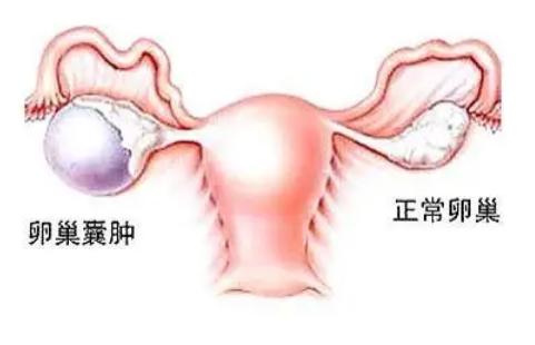 卵巢囊肿患者做试管适合长方案促排吗？