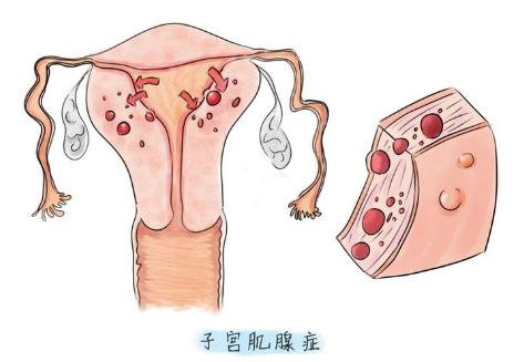 刮宫后得子宫腺肌病有什么症状，该如何治疗？