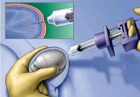男性做睾丸穿刺没有精子还有办法可以治疗吗？