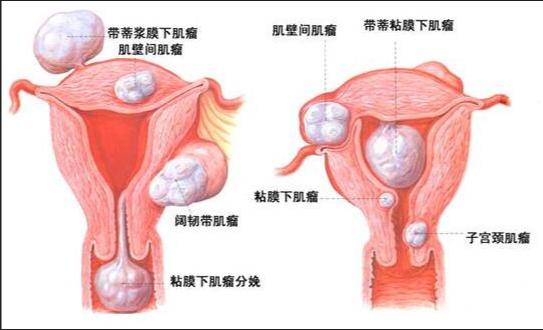 轻微子宫内膜炎试管失败两次第三次移植会成功吗？是否存在其他的辅助生育技术或治疗方法？