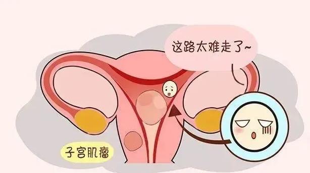 子宫腺肌瘤患者进行试管婴儿容易导致胎停吗？