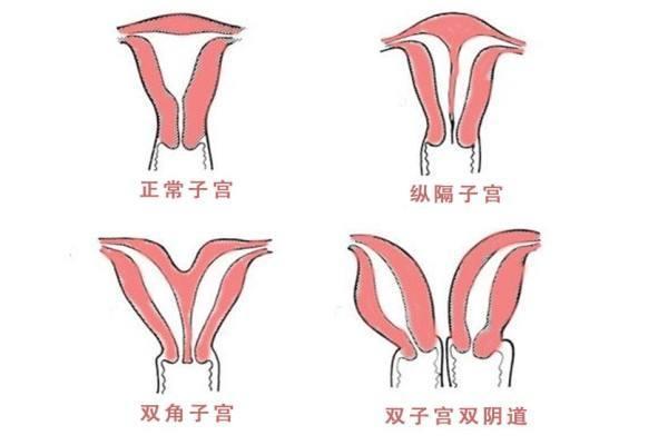 子宫发育畸形做试管移植两个囊胚怀双胞胎的几率高吗？