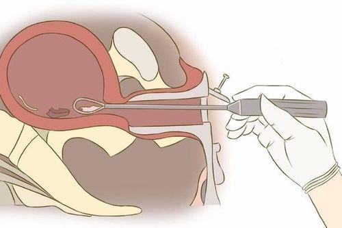 刮宫手术是否会影响后续做试管的成功率？
