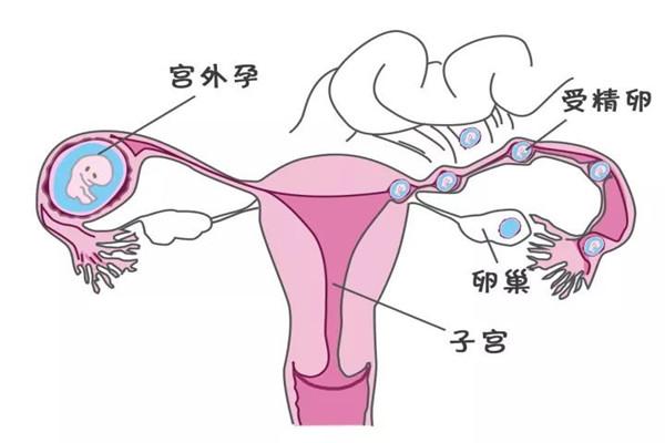 试管婴儿移植后宫外孕最早几天能发现？有哪些症状？
