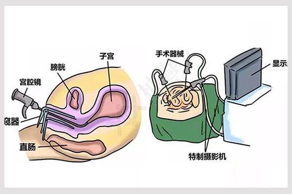 试管婴儿移植前需要做宫腔镜检查吗？检查有风险吗？