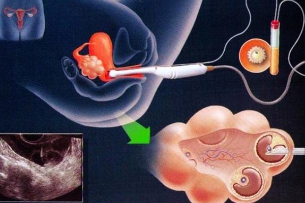 做试管婴儿的取卵针是从哪个位置进入取卵的？