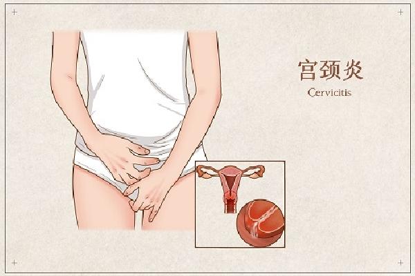 宫颈炎会影响试管婴儿着床吗？如何治疗宫颈炎？