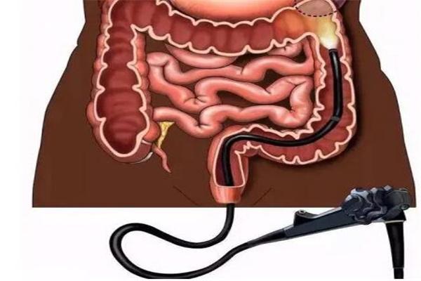 做肠镜检查有潜在并发症吗？具体有哪些并发症？