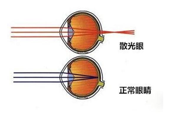 1岁儿童散光的原因是什么？这是先天疾病吗？