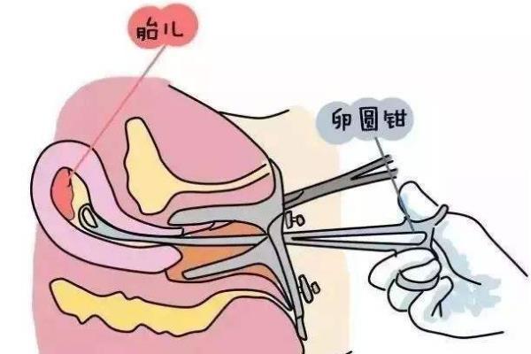 内膜厚刮宫是否等同于小产？该怎么恢复？