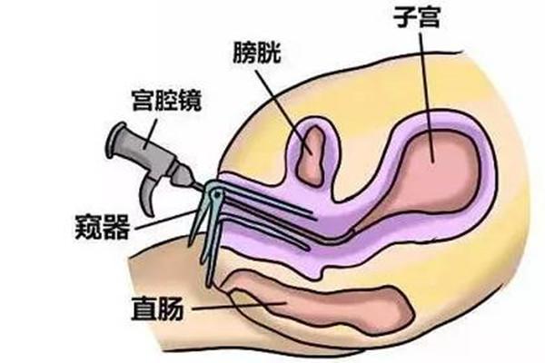 宫腔粘连患者在武汉哪家医院做试管婴儿成功率高？