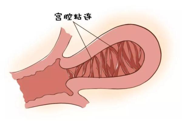 患有宫腔粘连在长沙做供卵试管婴儿需要排队等多久？