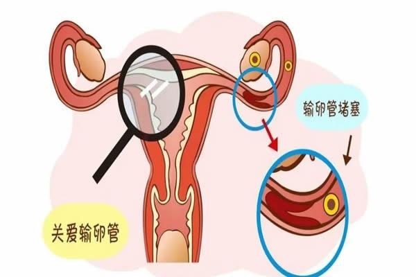 单侧输卵管堵塞在上海瑞金医院做试管婴儿的成功率是多少？