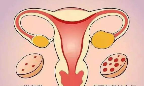 多囊卵巢综合征有什么方法能提高做试管的成功率？