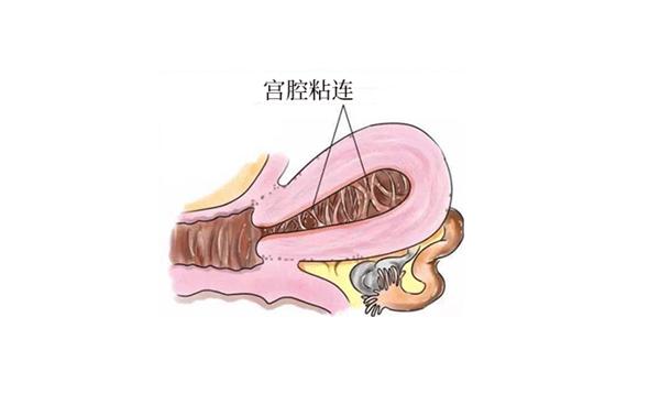 宫腔粘连为何不能直接做试管，看完你就知道了