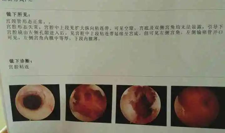 详述宫腔粘连三种保守治疗方法