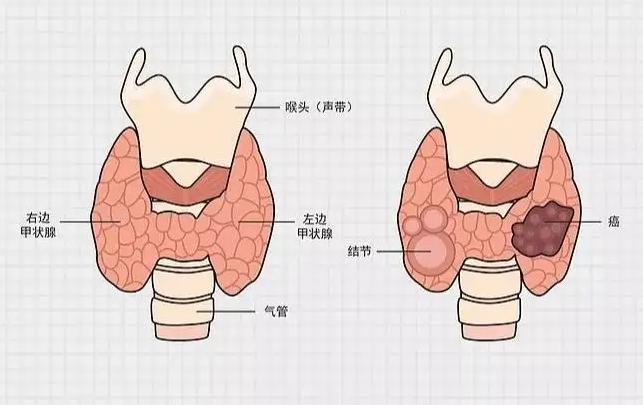 甲状腺癌做试管有什么影响，会影响试管成功率吗？