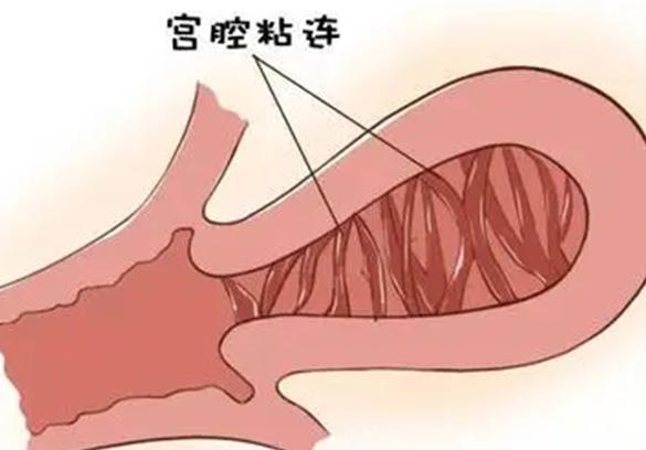 子宫粘连对试管手术有一定影响,需要注意什么吗