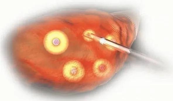 试管取卵出现中度腹水？打蛋白可以见效