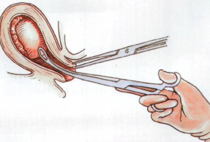 人流手术的过程是怎样的形式