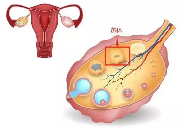 子宫黄体破裂出血严重吗？