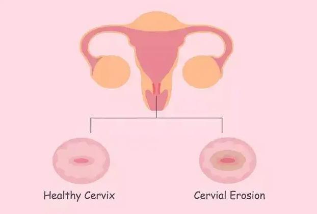 宫颈糜烂的症状是什么？