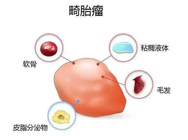 卵巢畸胎瘤怎么治疗？