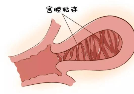 子宫粘连能做试管受孕吗，答案是当然可以