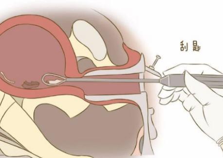 做试管前刮宫的作用大，主要是为了改善女性子宫环境