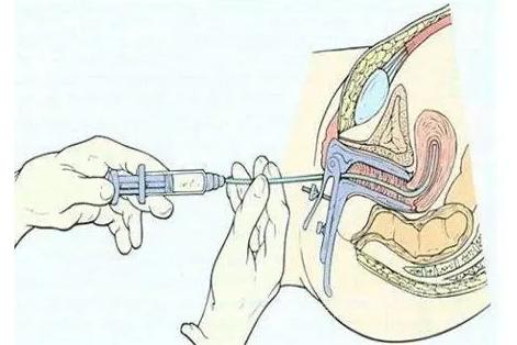 多囊患者做人工授精能成功吗？看完人工授精的流程你就知道了