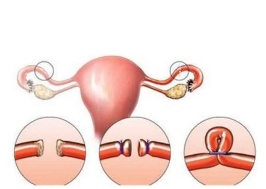 女性不开刀可以结扎吗,女性不开刀的结扎方法是什么