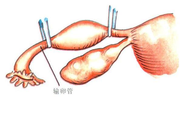 输卵管两边切除了还可以接吗?没了输卵管可以做试管吗?