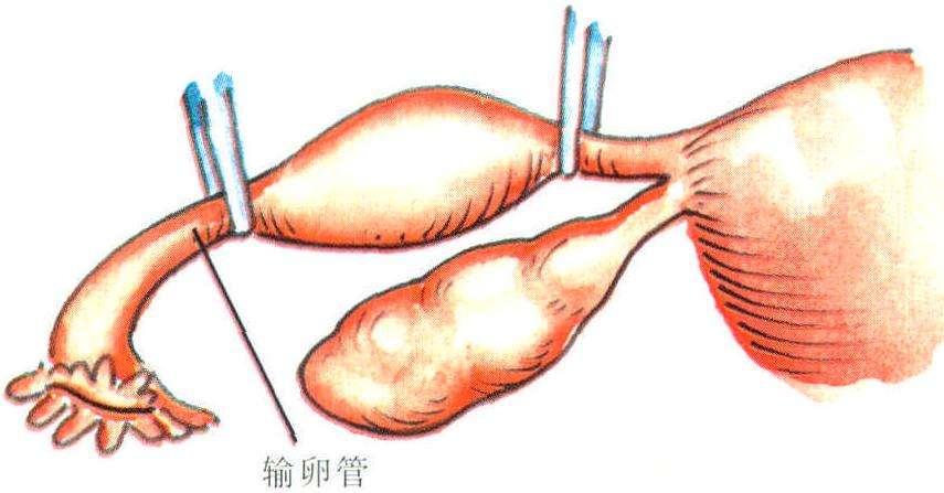 输卵管结扎后还能进行人工受孕吗？一起探索事实真相