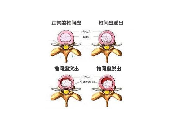 试管移植必知：腰间盘突会影响移植效果吗