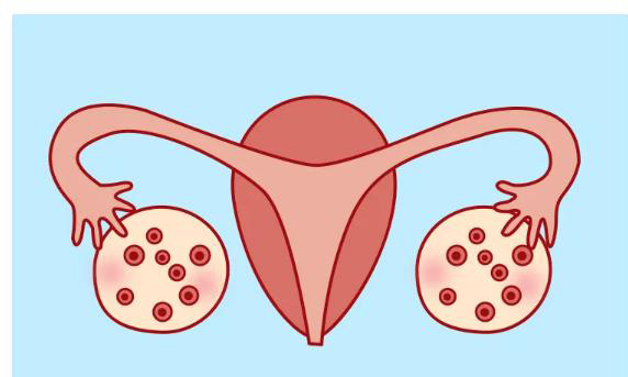 女性患有多囊卵巢综合征还能怀孕生孩子吗？